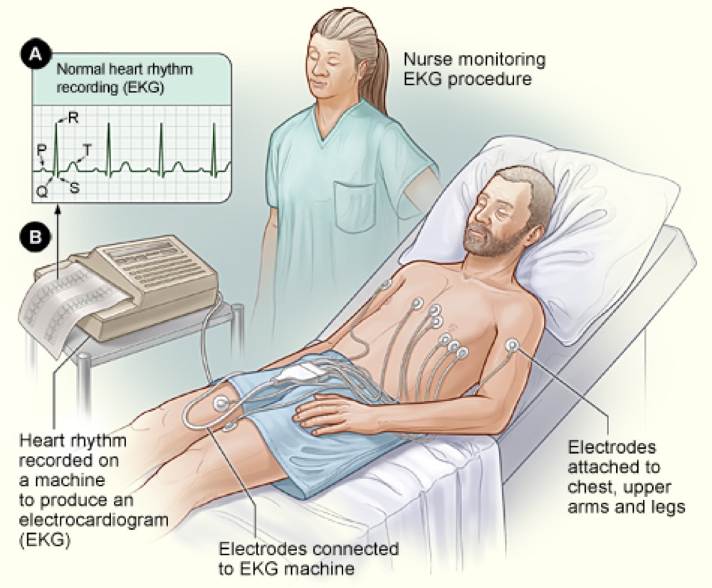 ECG